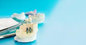 השיטות השונות של הליך השתלת שיניים