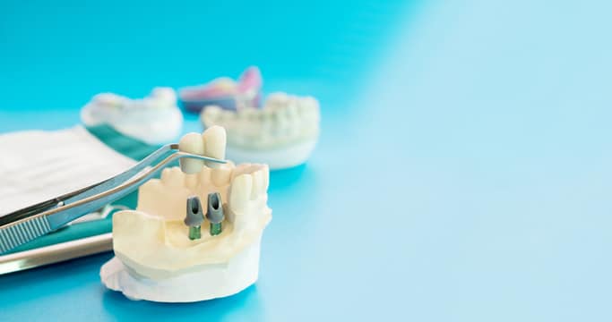 השיטות השונות של הליך השתלת שיניים