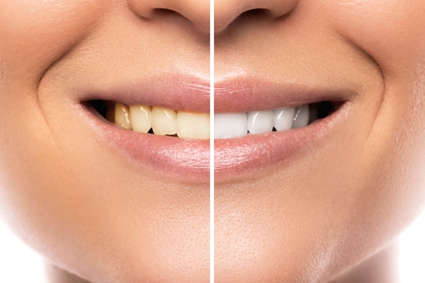 תמונות-שיניים-לפני-ואחרי